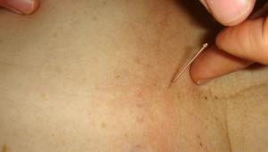 Utilizar acupuntura para adelgazar