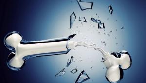 ¿Prevenir la osteoporosis?